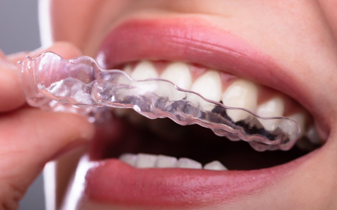 Clear Aligners Invisalign